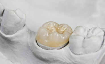 emax-restoration-dental-lab-agoura-hills