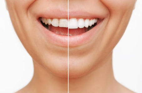 porcelain-veneers-agoura-hills