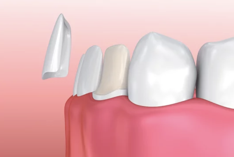 porcelain-veneers-agoura-dental-lab