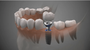 dental-implant-agoura