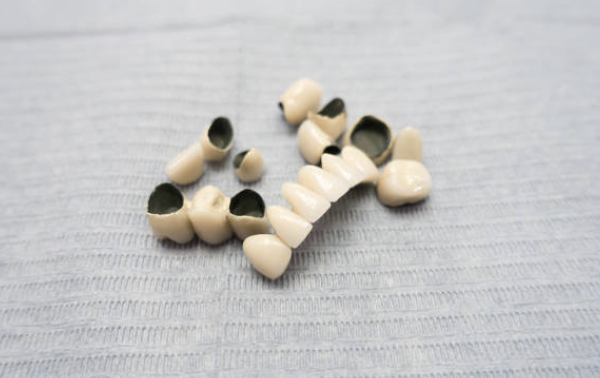 PFM-Dental-Lab-agoura-hills