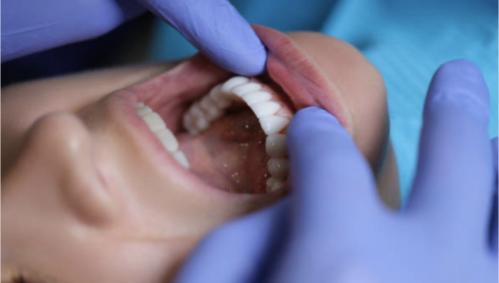 dental-lab-porcelain-veneers