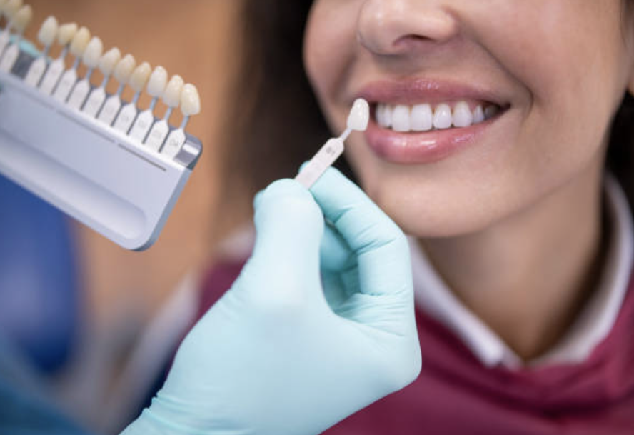 porcelain-veneers-dental-lab-los-angeles