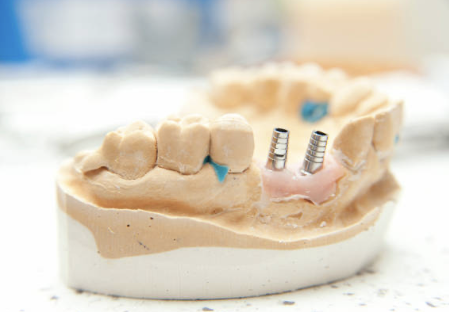 dental-lap-dental-implant-restorations