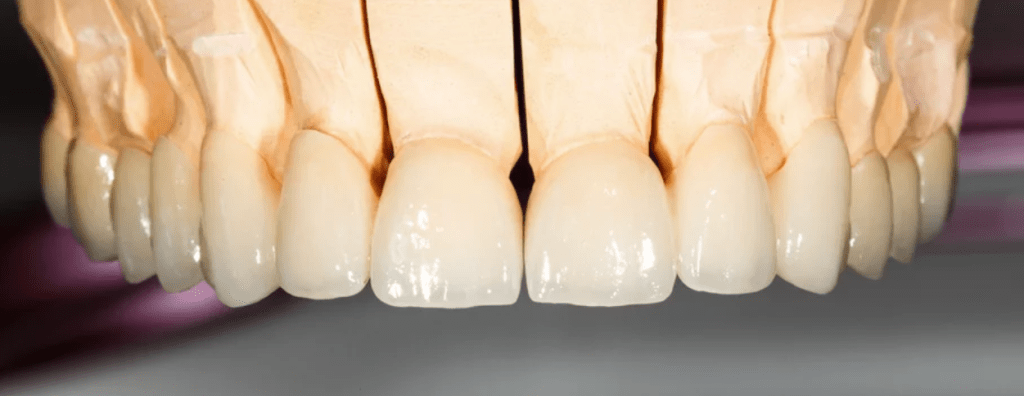 zirconia-restoration-dental-lab
