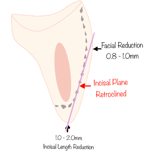 veneer-prep-retroclined-guide