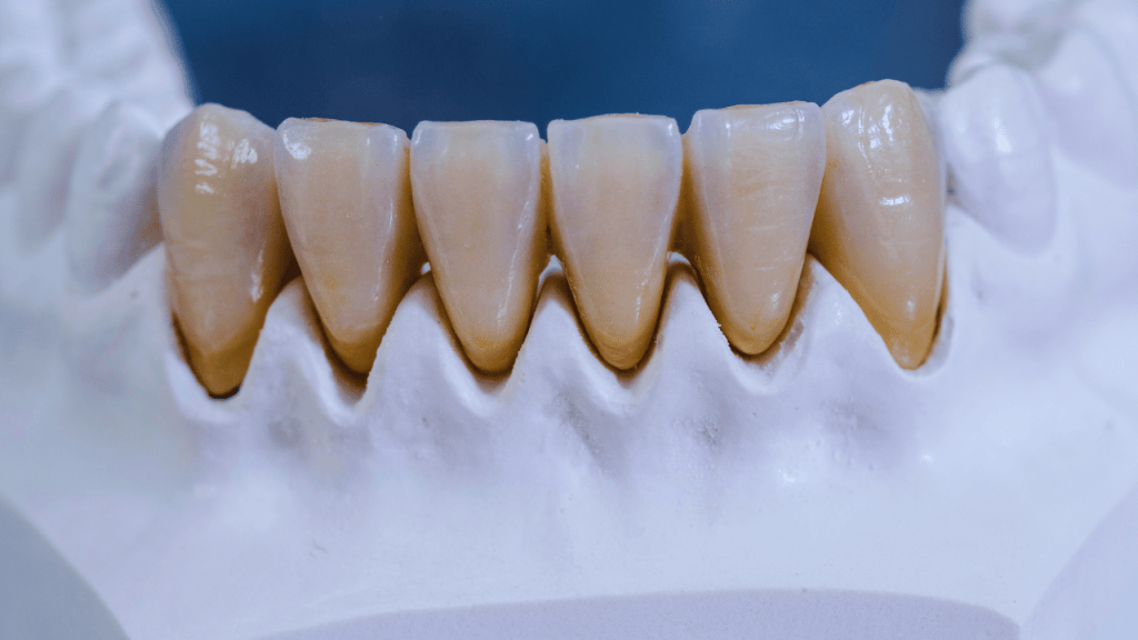 emax-vs-zirconia